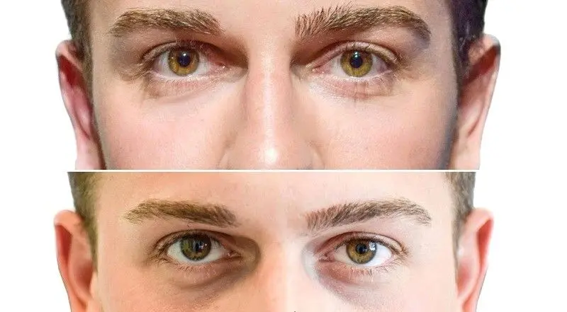 بهترین دکتر تزریق فیلر زیر چشم در اصفهان 