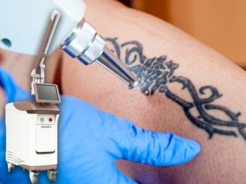 ریموو تاتو با دستگاه کیوسوئیچ