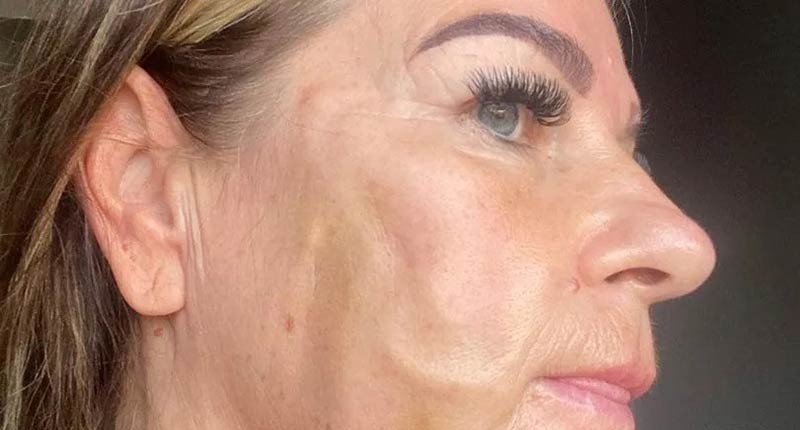راهنمای کامل لیفت صورت با نخ