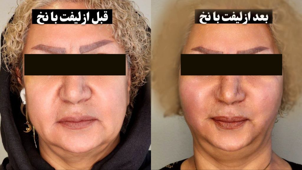 ماندگاری لیفت صورت با نخ چقدر است؟