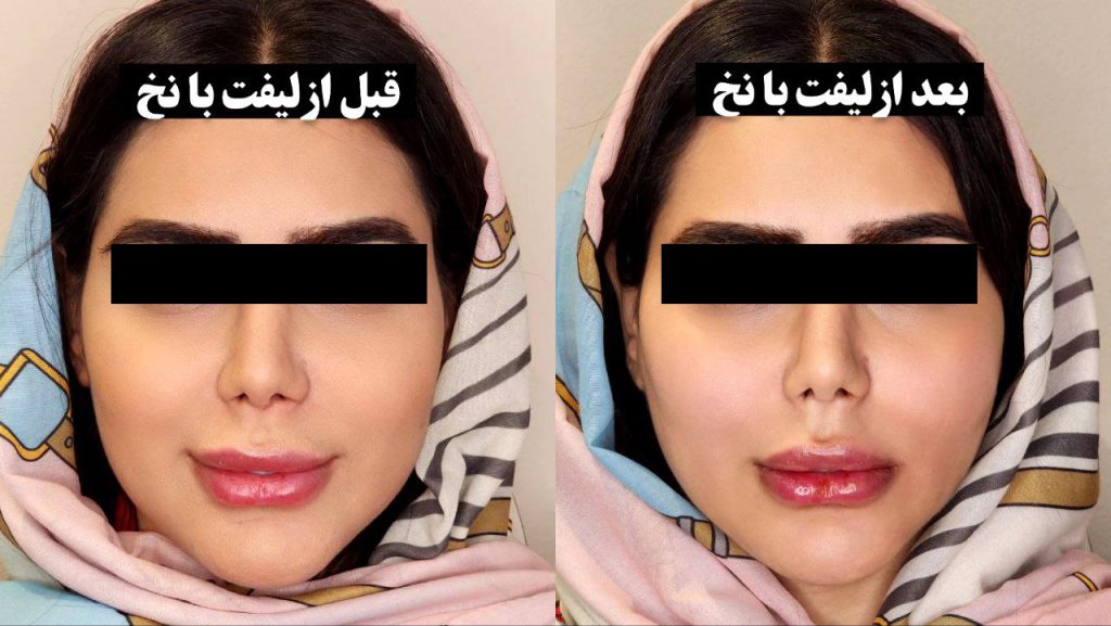 ماندگاری لیفت صورت با نخ چقدر است؟