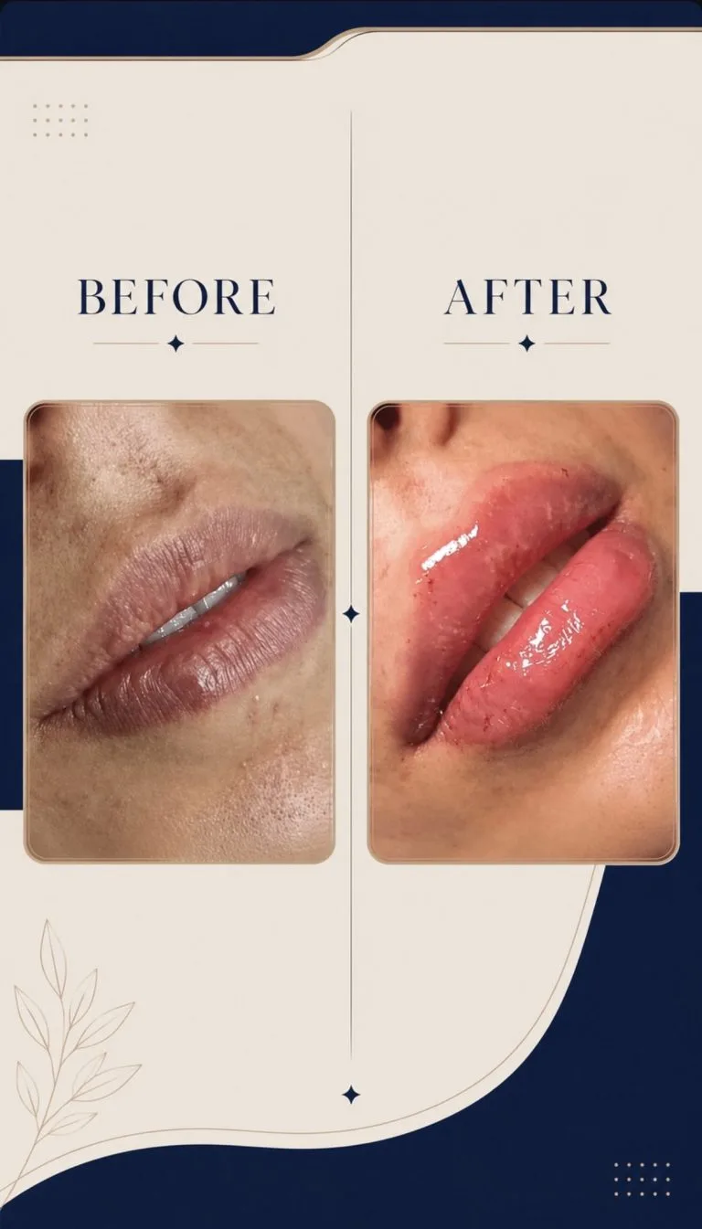 تزریق ژل و بوتاکس در اصفهان