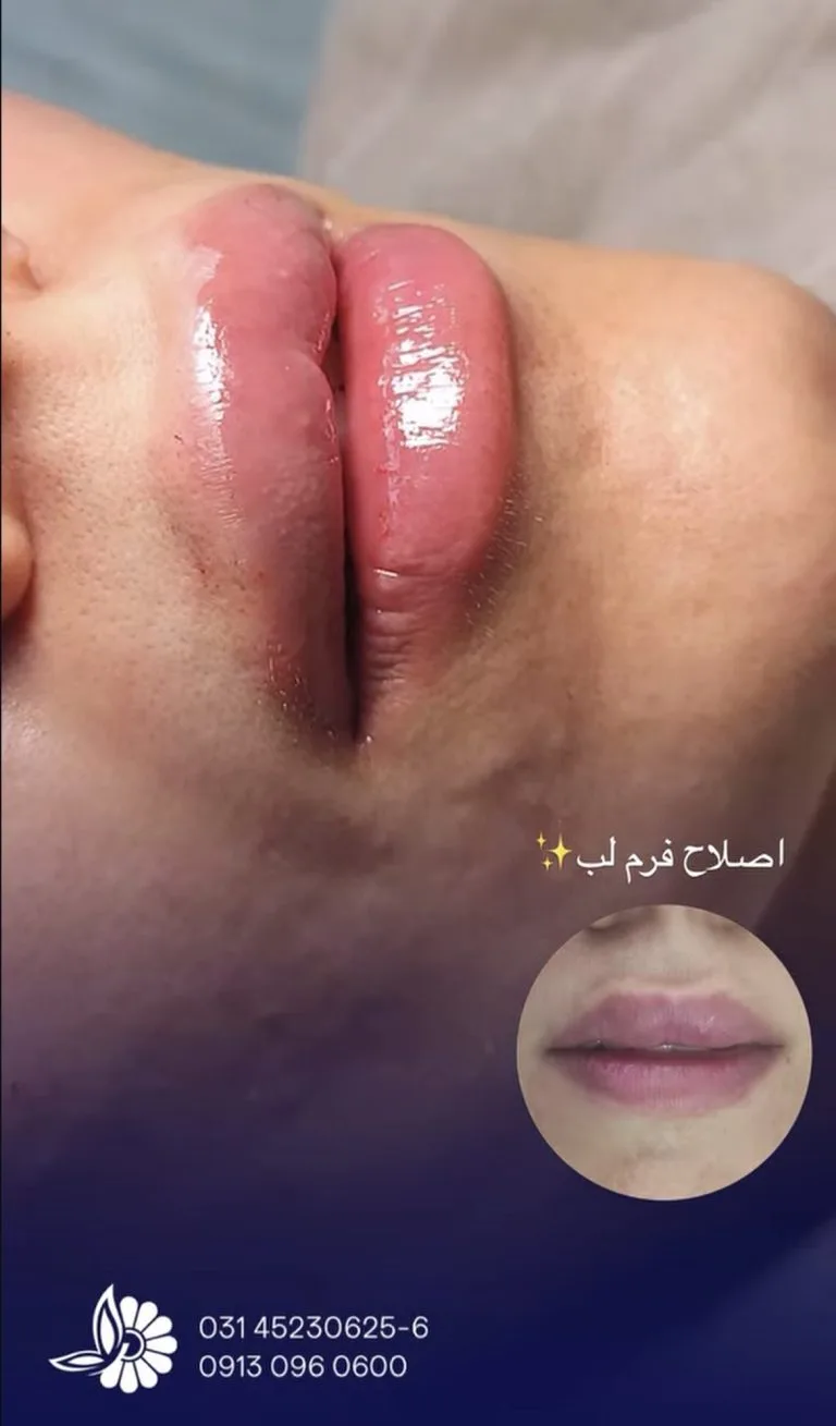 تزریق ژل و بوتاکس در اصفهان