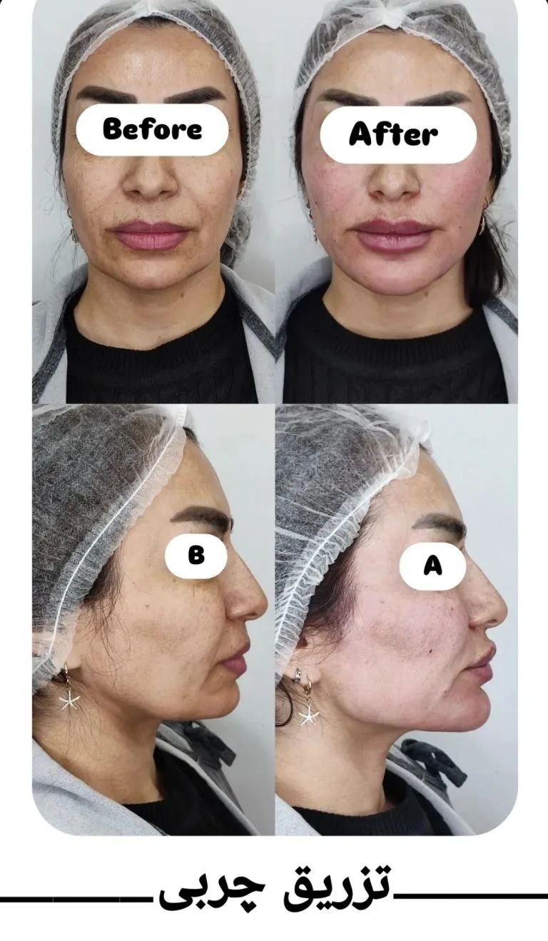 بهترین دکتر تزریق چربی به صورت در اصفهان