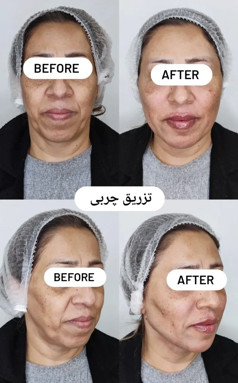 بهترین دکتر تزریق چربی به صورت در اصفهان