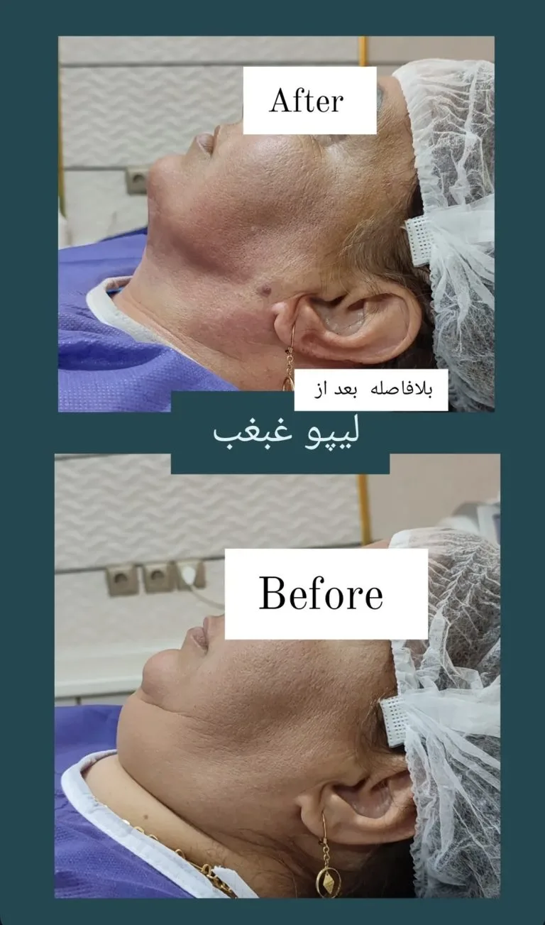 بهترین دکتر رفع غبغب در اصفهان