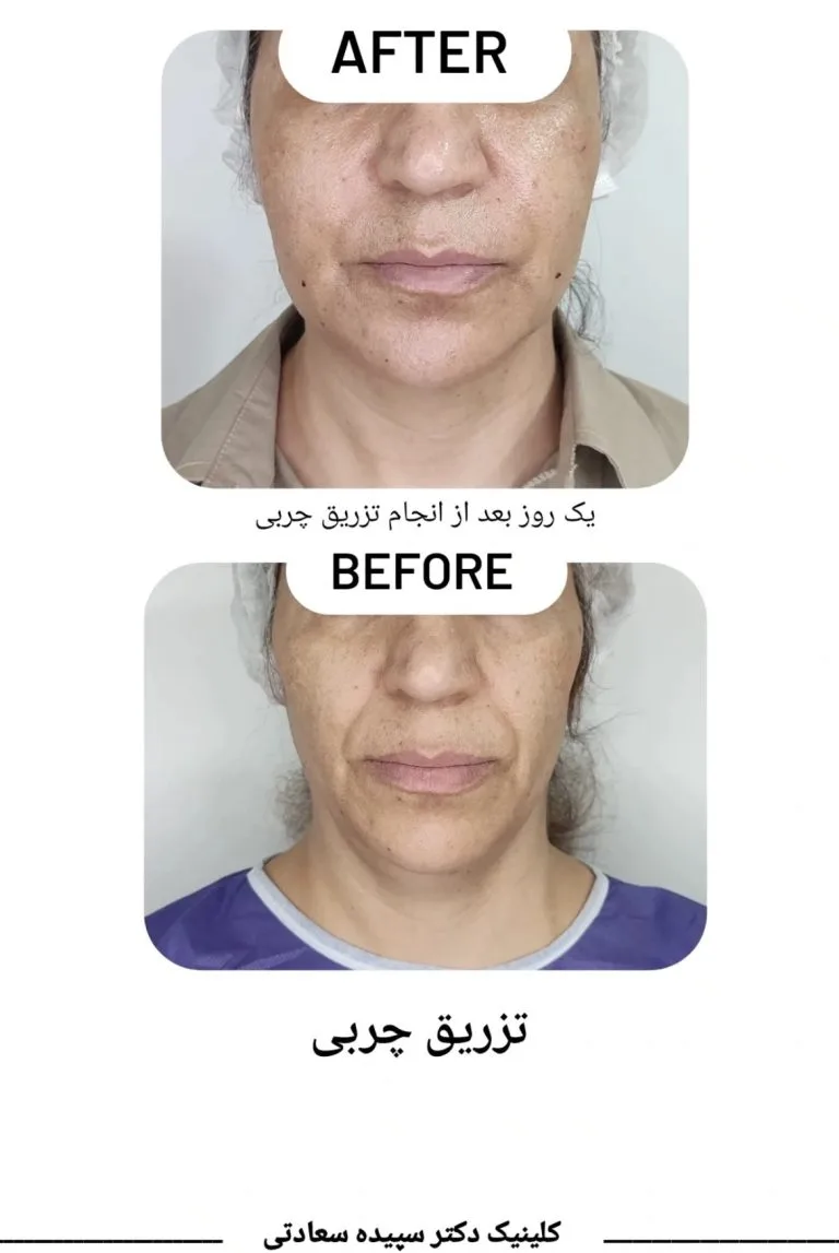 بهترین دکتر تزریق چربی به صورت در اصفهان
