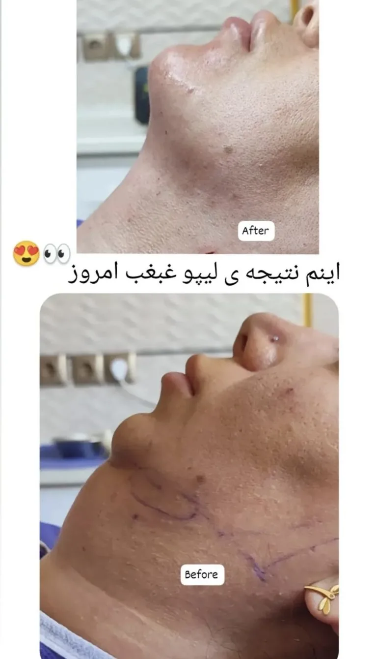 بهترین دکتر رفع غبغب در اصفهان