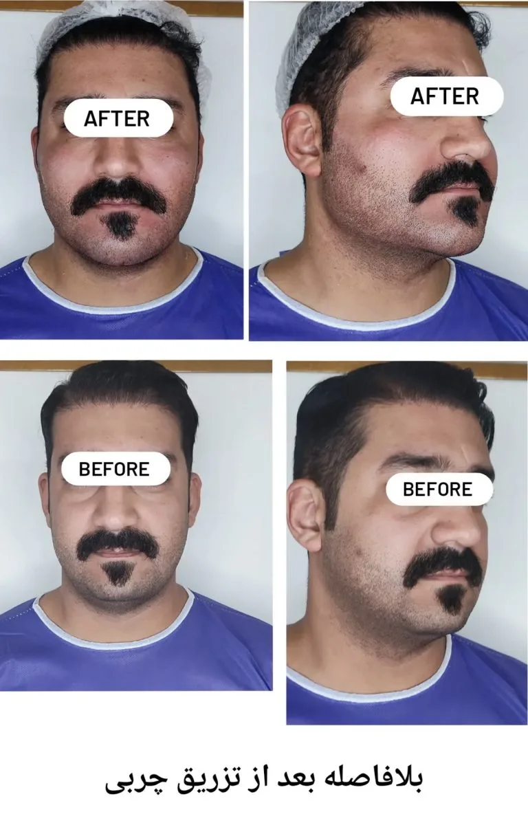 بهترین دکتر تزریق چربی به صورت در اصفهان