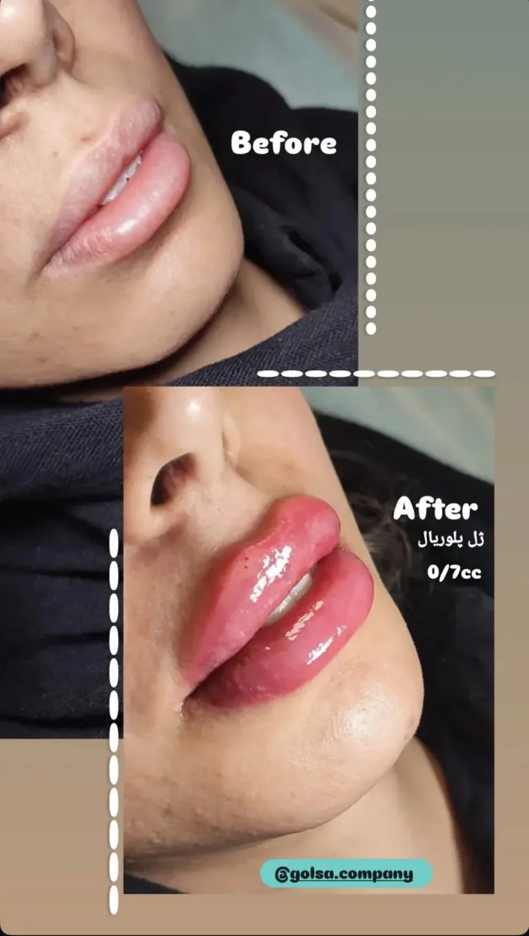 تزریق ژل و بوتاکس در اصفهان