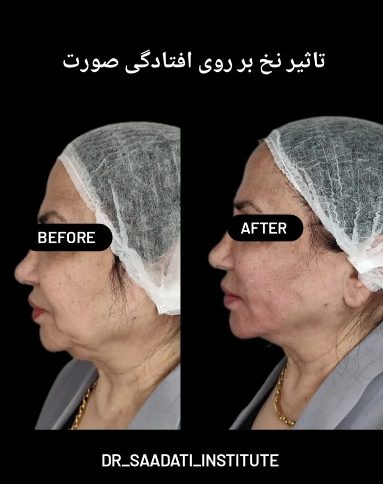 لیفت صورت با نخ در اصفهان