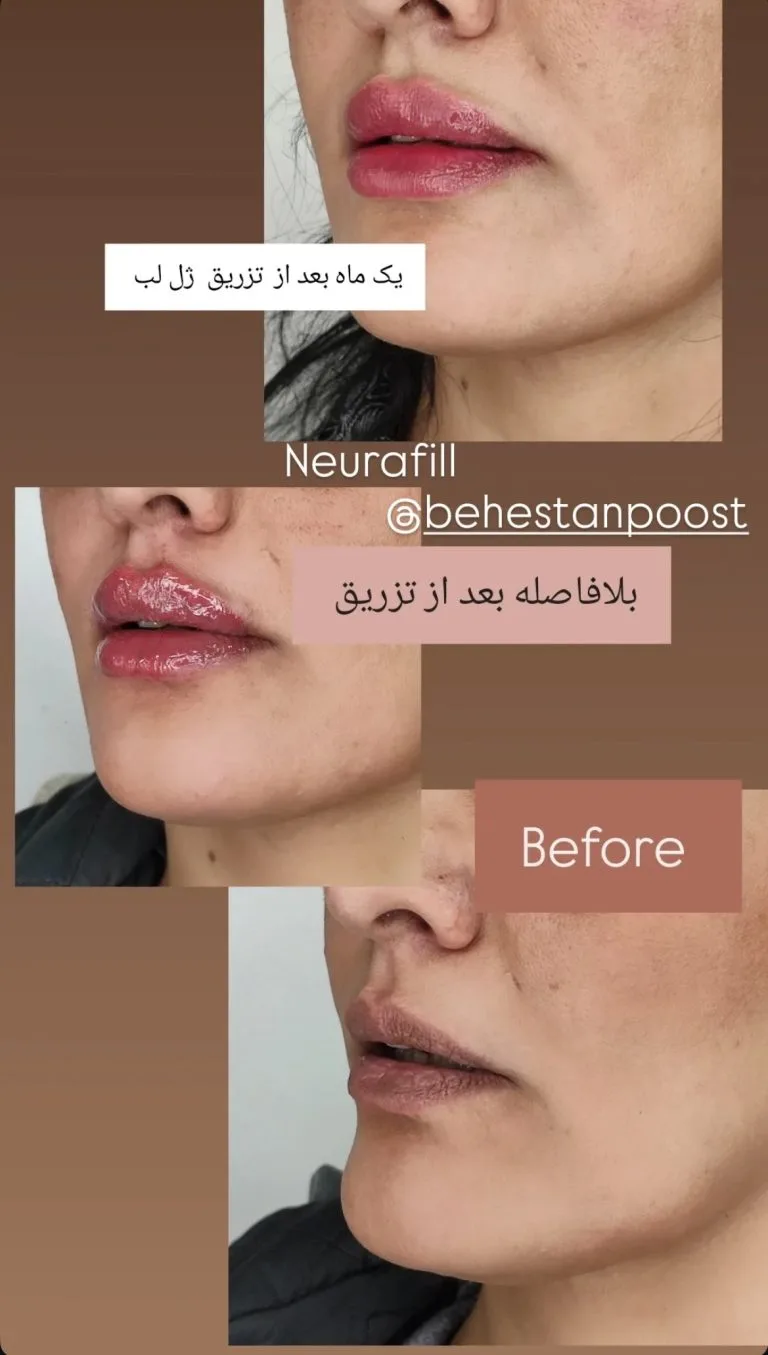 تزریق ژل و بوتاکس در اصفهان