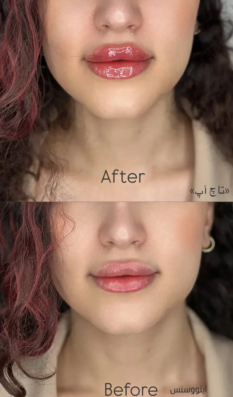 تزریق ژل و بوتاکس در اصفهان
