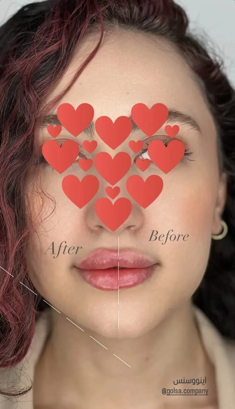 تزریق ژل و بوتاکس در اصفهان