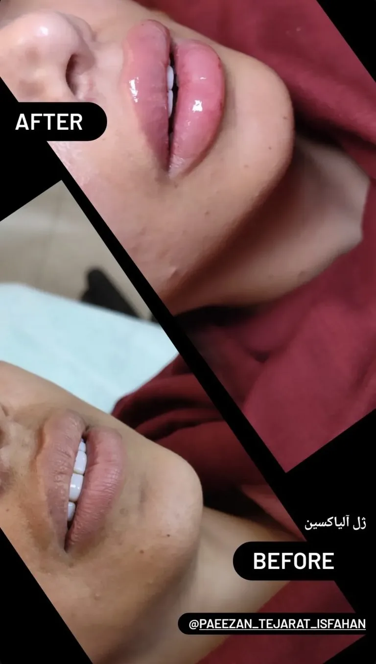 تزریق ژل و بوتاکس در اصفهان