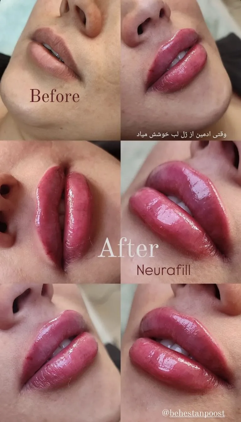 تزریق ژل و بوتاکس در اصفهان