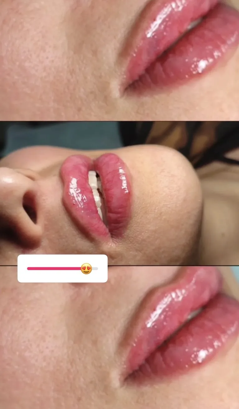 تزریق ژل و بوتاکس در اصفهان