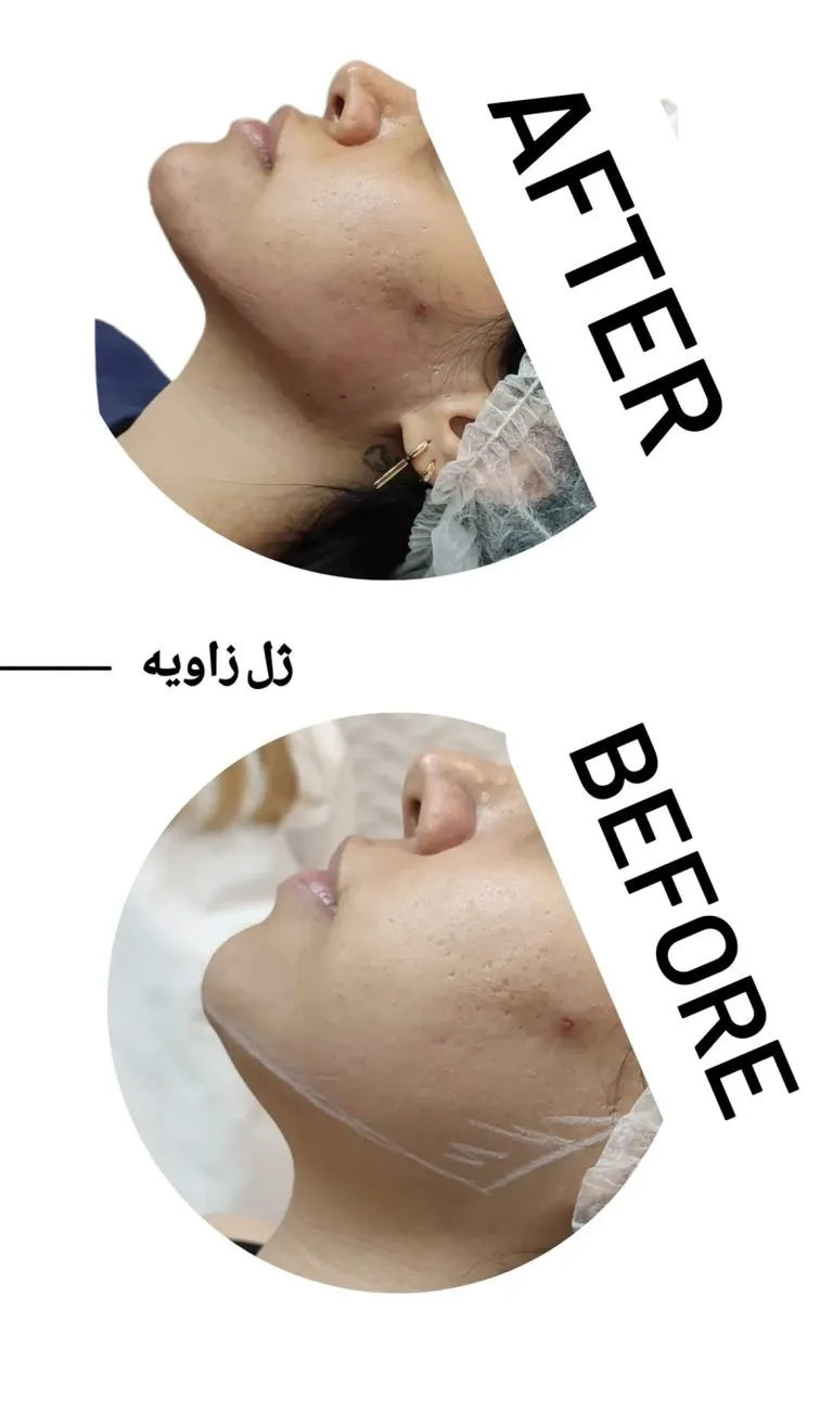 تزریق ژل و بوتاکس در اصفهان
