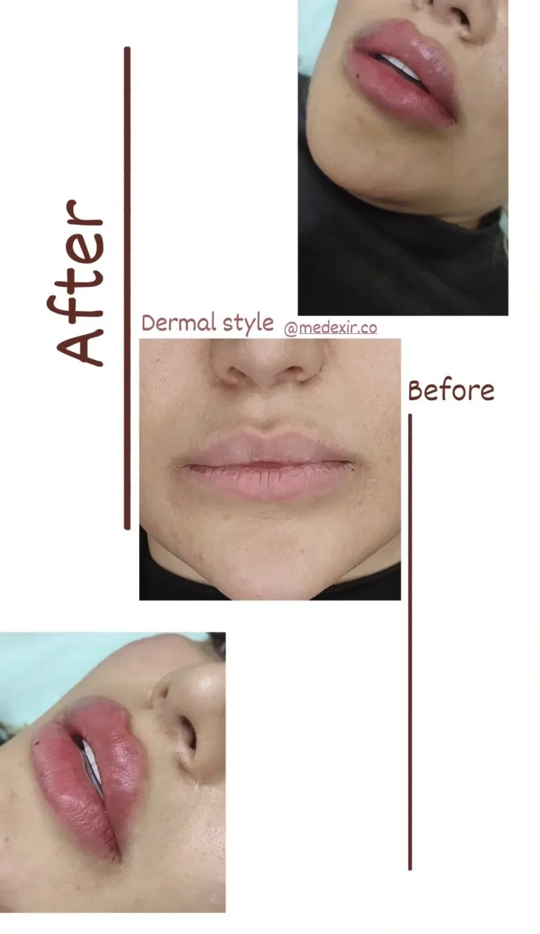 تزریق ژل و بوتاکس در اصفهان