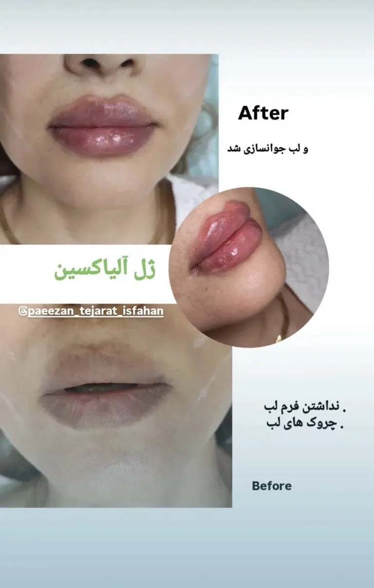 تزریق ژل و بوتاکس در اصفهان