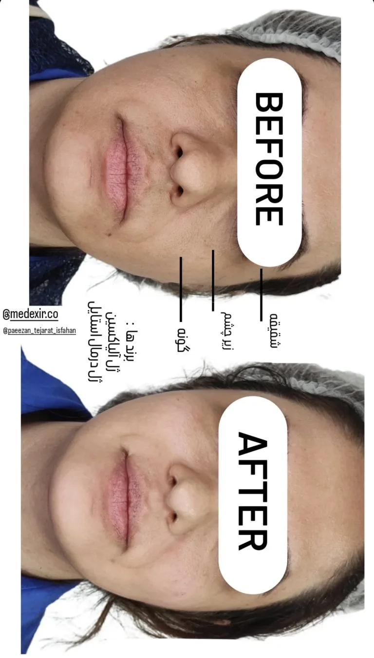 تزریق ژل و بوتاکس در اصفهان