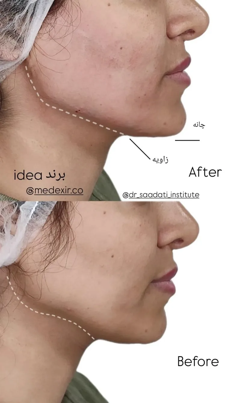 تزریق ژل و بوتاکس در اصفهان