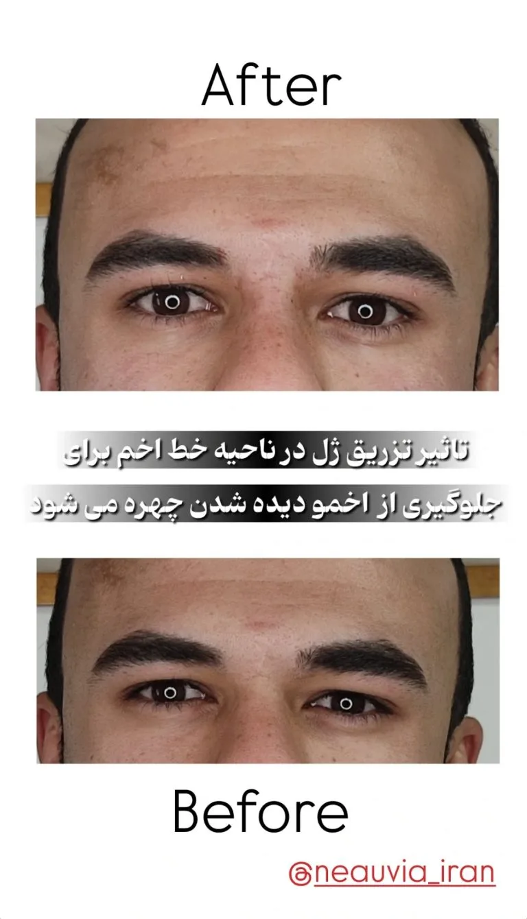 تزریق ژل و بوتاکس در اصفهان