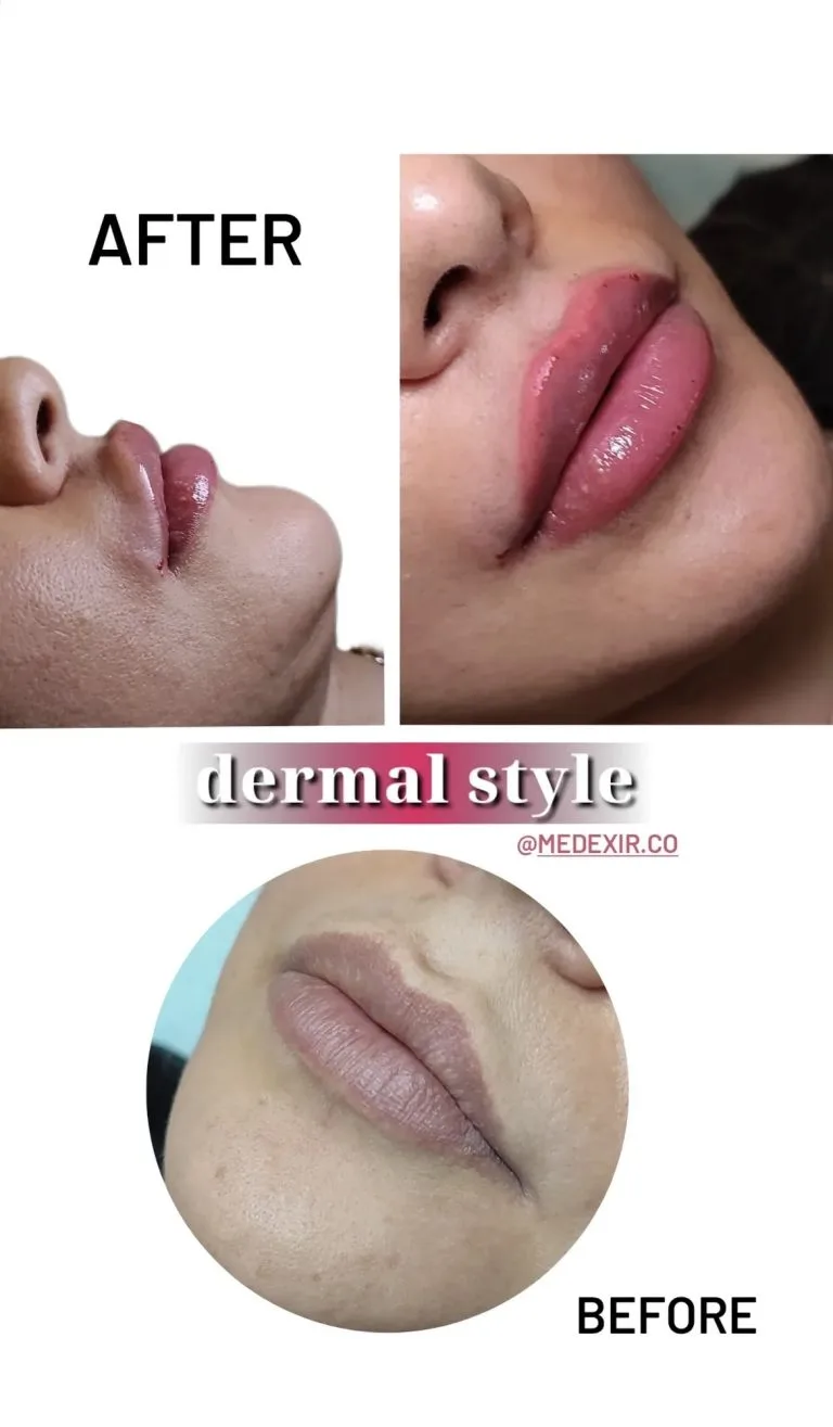 تزریق ژل و بوتاکس در اصفهان