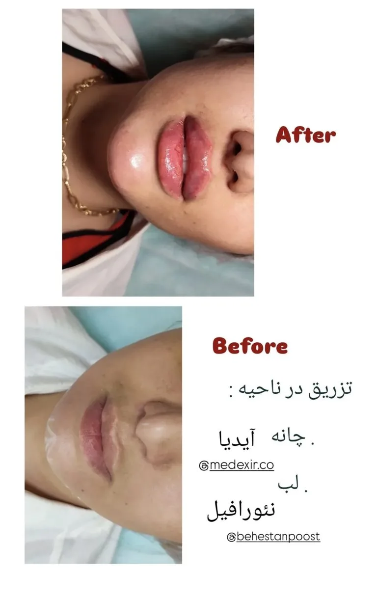 تزریق ژل و بوتاکس در اصفهان