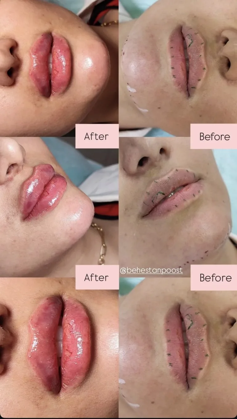 تزریق ژل و بوتاکس در اصفهان