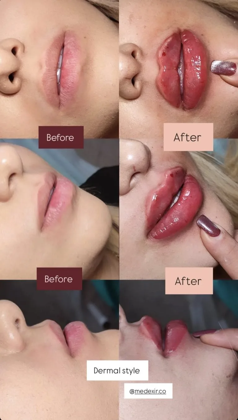 تزریق ژل و بوتاکس در اصفهان