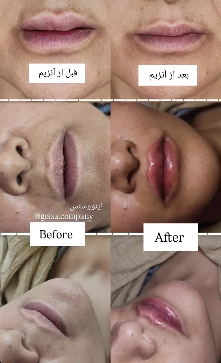 تزریق ژل و بوتاکس در اصفهان