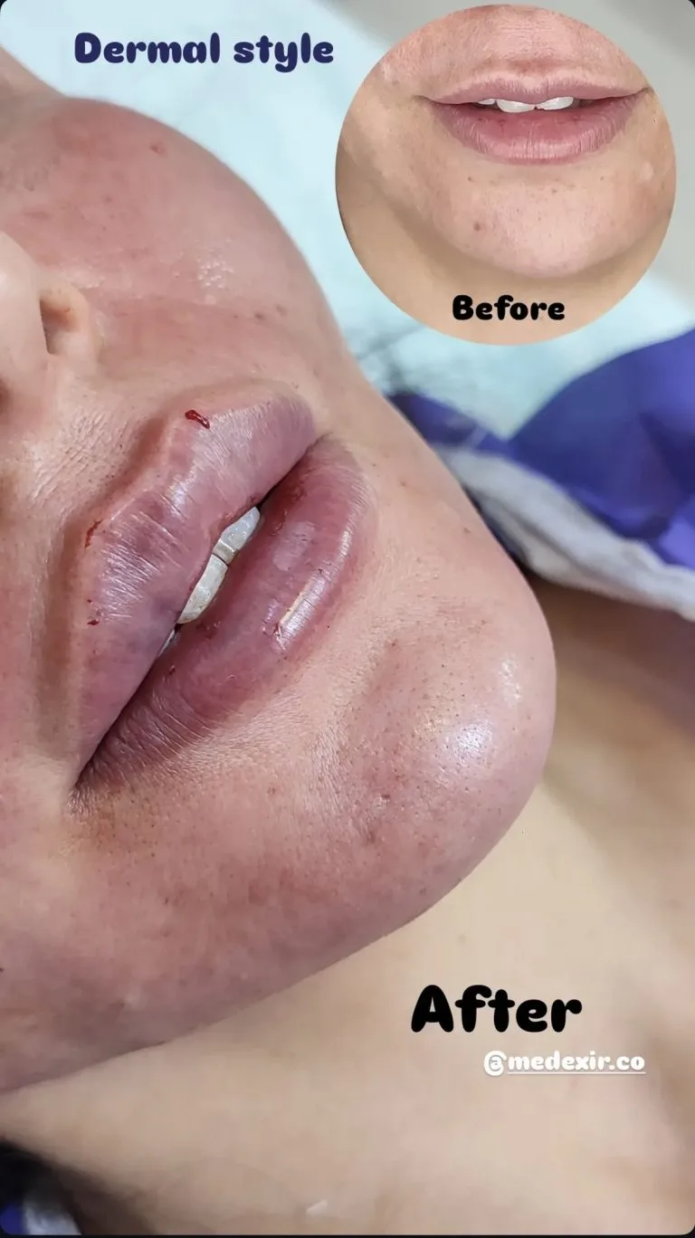 تزریق ژل و بوتاکس در اصفهان