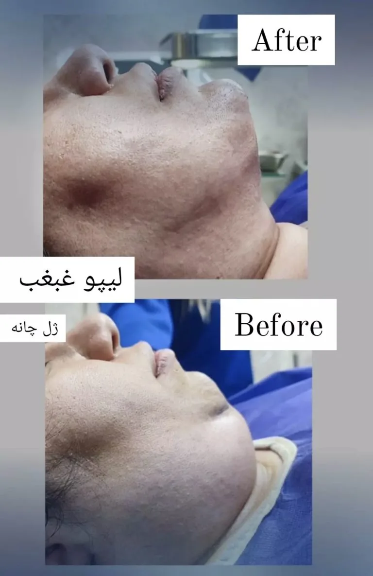 بهترین دکتر رفع غبغب در اصفهان