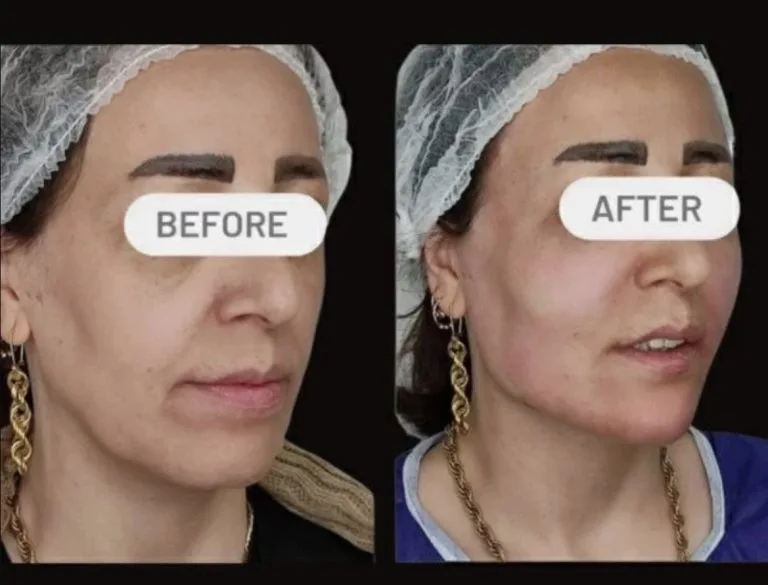 بهترین دکتر تزریق چربی به صورت در اصفهان