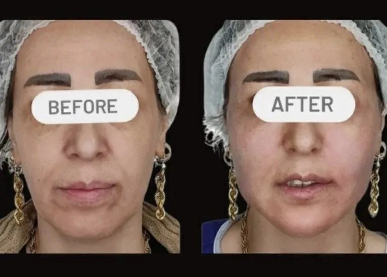 بهترین دکتر تزریق چربی به صورت در اصفهان